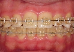 矯正装置5。審美矯正ロジウムコートワイヤーの装着症例の写真(サンキンクリアブラケット使用 上顎ノーマル矯正ワイヤー/下顎:ロジウムコートホワイト矯正ワイヤー)