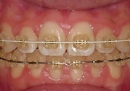 矯正装置5。審美矯正whiteワイヤーの装着症例の写真(クリアブラケット)。