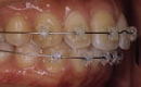 矯正症例、術中。クリアーブラケット