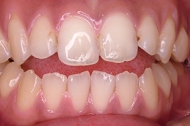 矯正症例、術前。オープンバイトの不正咬合