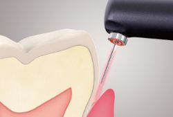 diagnodentレーザー検出器のぺリオの図